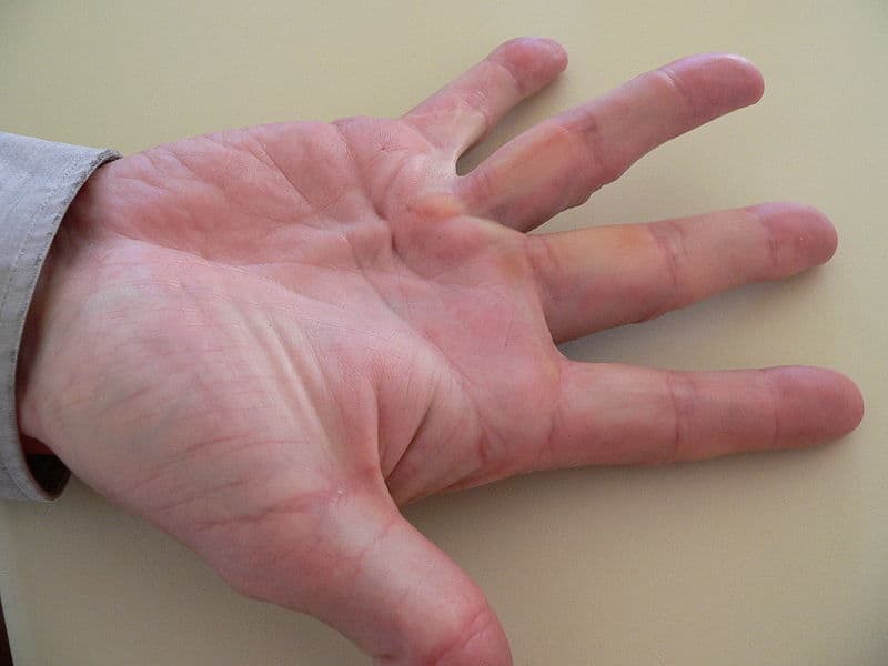 Dupytren's Contracture