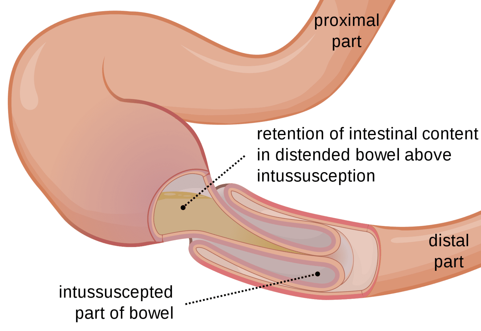 Intussusception - almostadoctor