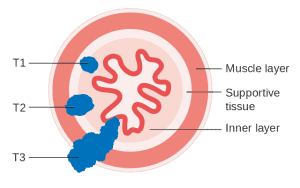 Read more about the article Oesophageal Tumours