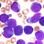 Leukaemia