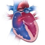 ASD – Atrial Septal Defect