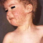 Measles