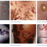 Bullous Pemphigoid