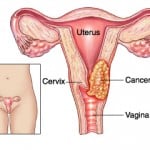 Cervical Cancer and CIN