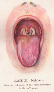 Read more about the article Diphtheria