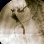 Obstructive Jaundice