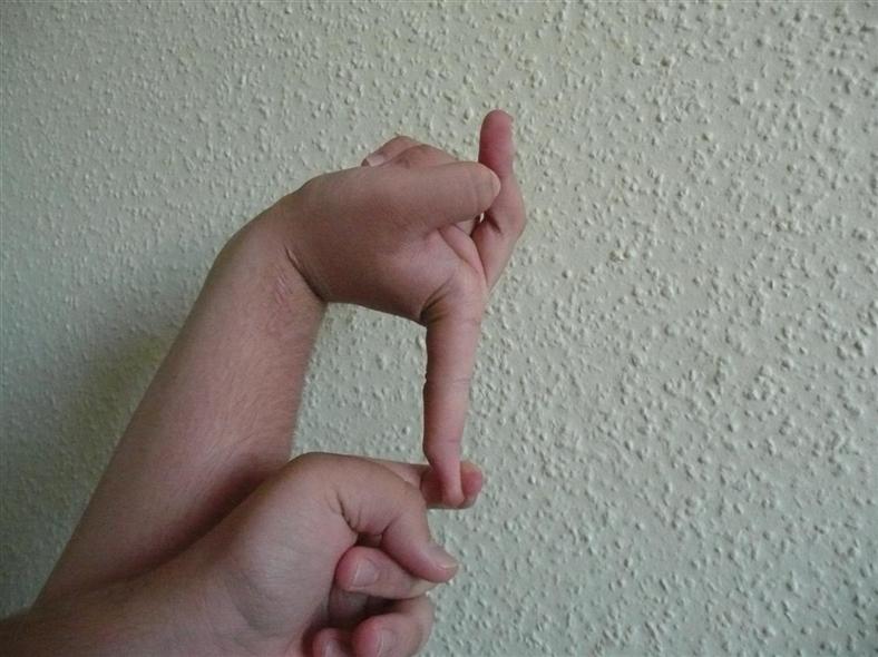 Ehlers-Danlos Syndrome