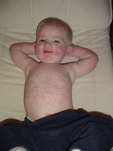 Read more about the article Fifth Disease