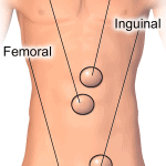 Hernias
