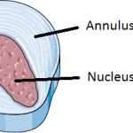 Sciatica and intervertebral disc prolapse