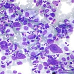 Lymphoma