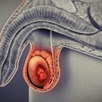 Testicular Cancer