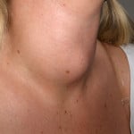 Hyperthyroidism (Thyrotoxicosis)