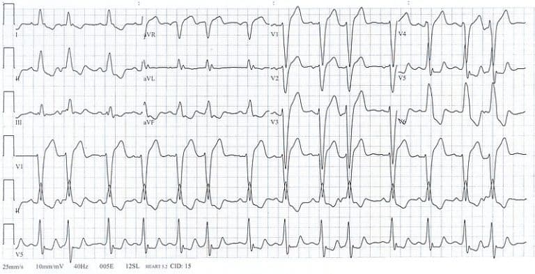 Myocardial Infarction And Acute Coronary Syndromes ACS Almostadoctor