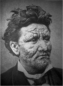 Read more about the article Leprosy