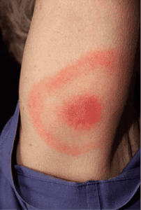 Read more about the article Lyme Disease