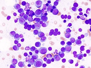 Read more about the article Myeloma