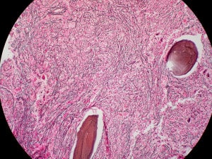 Read more about the article Myelofibrosis