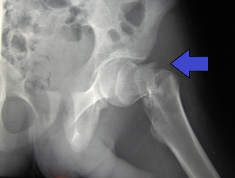 Hip Fracture (Neck of Femur / NOF) - almostadoctor