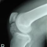 Osteochondroma