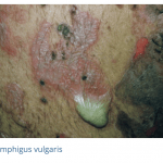 Bullous Pemphigus