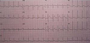 Read more about the article Pericarditis