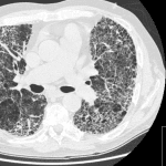 Interstitial Lung Disease and Pulmonary Fibrosis
