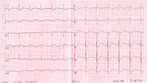ECG Abnormalities - almostadoctor