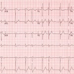 Atrial Fibrillation – AF