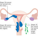 Endometrial Carcinoma