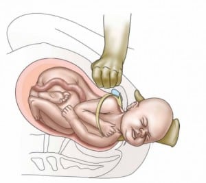 Read more about the article Dystocia