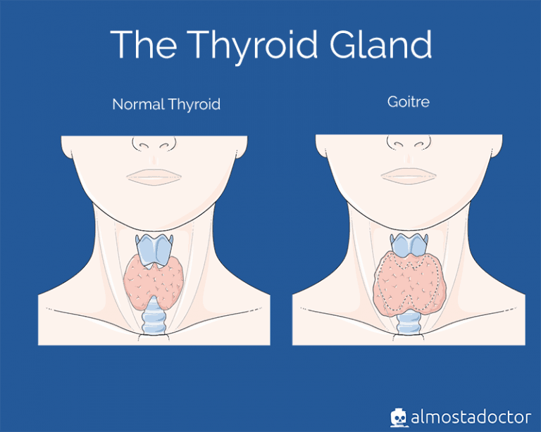 Hypothyroidism almostadoctor