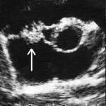 Infective Endocarditis
