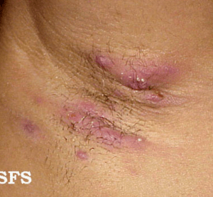 Read more about the article Hidradenitis suppurativa
