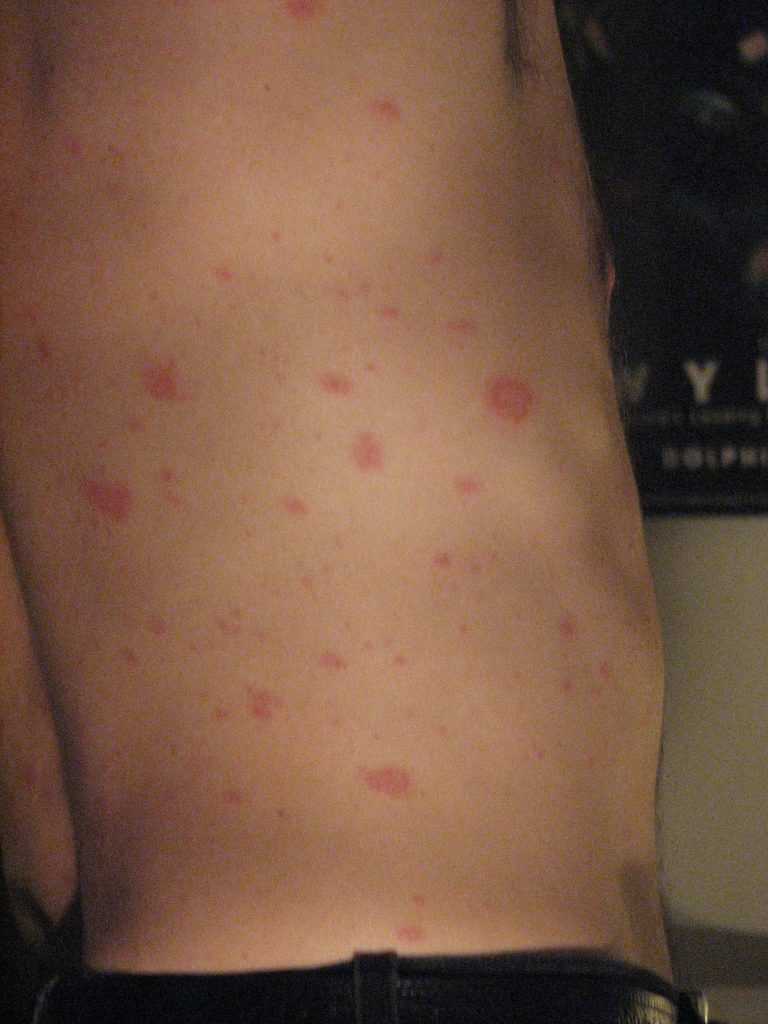 Pityriasis Rosea Arms
