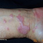 Lichen planus