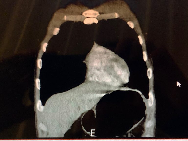 Retrograde Cricopharyngeus Dysfunction (R-CPD) - almostadoctor