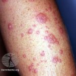 Erythema Multiforme