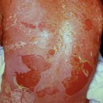 Stephens-Johnson Syndrome – SJS