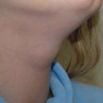 Thyroglossal cyst