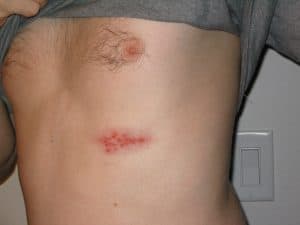 Read more about the article Shingles