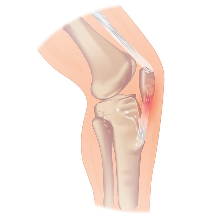 Knee pain. This file is taken from wikimedia commons and is licensed under the Creative Commons Attribution-Share Alike 3.0 Unported license.
